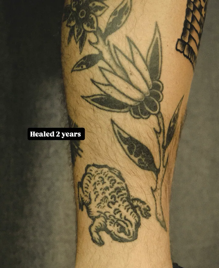 Flowers and a toad on a leg, two years healed, with his own story label